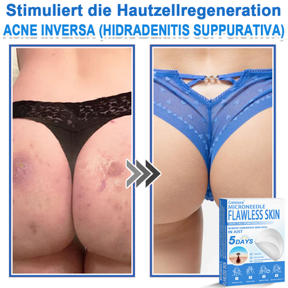 👩‍⚕️ Curalona® 2-in-1 Microneedle & Hydrocolloid Patches | Advanced Skin Care Patches for Blemishes, Skin Tags & Uneven Skin Texture | Helps Improve the Look of Fine Lines, Marks & Imperfections | Invisible Star Spot Patches for Face & Body