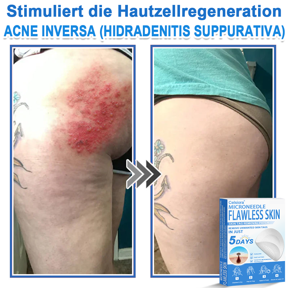 👩‍⚕️ Curalona® 2-in-1 Microneedle & Hydrocolloid Patches | Advanced Skin Care Patches for Blemishes, Skin Tags & Uneven Skin Texture | Helps Improve the Look of Fine Lines, Marks & Imperfections | Invisible Star Spot Patches for Face & Body