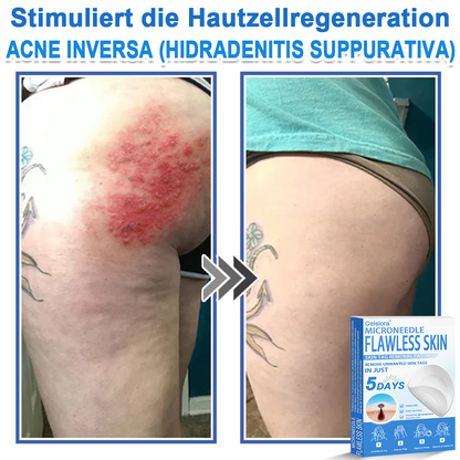 👩‍⚕️ Curalona® 2-in-1 Microneedle & Hydrocolloid Patches | Advanced Skin Care Patches for Blemishes, Skin Tags & Uneven Skin Texture | Helps Improve the Look of Fine Lines, Marks & Imperfections | Invisible Star Spot Patches for Face & Body
