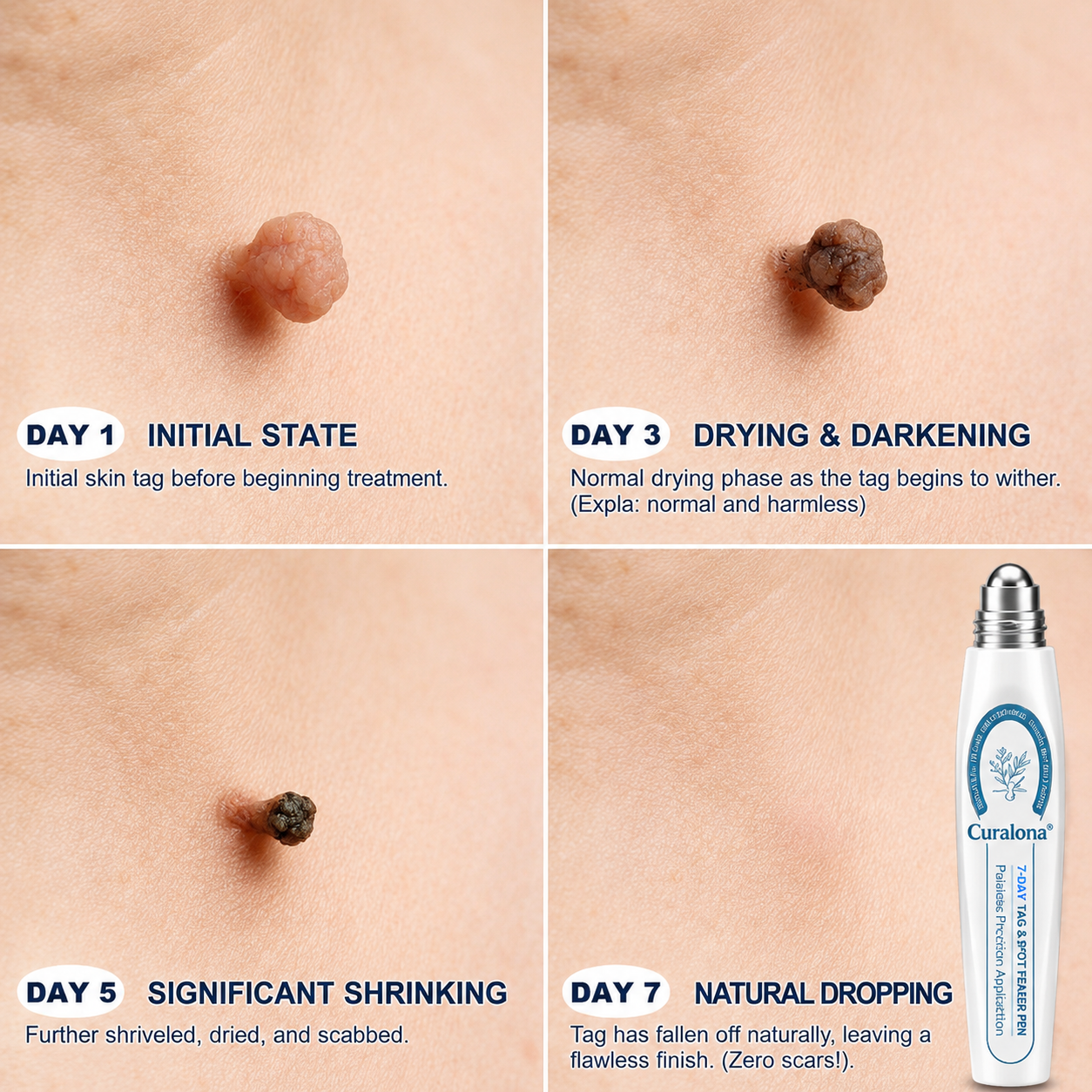 🔥𝐎𝐟𝐟𝐢𝐜𝐢𝐚𝐥 𝐁𝐫𝐚𝐧𝐝 𝐒𝐭𝐨𝐫𝐞 |✅💎Curalona® 7-𝐷𝑎𝑦 𝗧𝐚𝐠 & 𝗦𝗽𝐨𝐭 𝐄𝐫𝒂𝒔𝒆𝒓(Zero Pain, Zero 𝐒𝐜𝐚𝒓𝒔 Rollerball)
