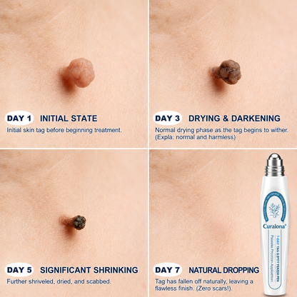 🔥𝐎𝐟𝐟𝐢𝐜𝐢𝐚𝐥 𝐁𝐫𝐚𝐧𝐝 𝐒𝐭𝐨𝐫𝐞 |✅💎Curalona® 7-𝐷𝑎𝑦 𝗧𝐚𝐠 & 𝗦𝗽𝐨𝐭 𝐄𝐫𝒂𝒔𝒆𝒓(Zero Pain, Zero 𝐒𝐜𝐚𝒓𝒔 Rollerball)