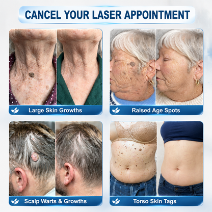 𝐎𝐟𝐟𝐢𝐜𝐢𝐚𝐥 𝐁𝐫𝐚𝐧𝐝 𝐒𝐭𝐨𝐫𝐞 |✅💎Curalona® 7-𝐷𝑎𝑦 𝗧𝐚𝐠 & 𝗦𝗽𝐨𝐭 𝐄𝐫𝒂𝒔𝒆𝒓(Zero Pain, Zero 𝐒𝐜𝐚𝒓𝒔 Rollerball)
