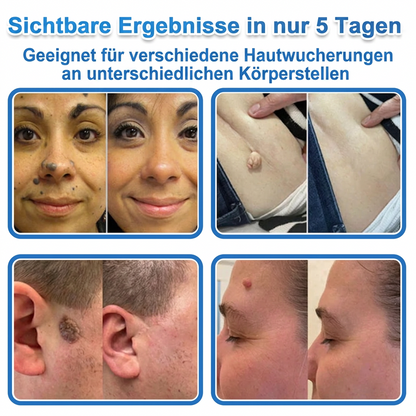 👩‍⚕️ Curalona® 2-in-1 Microneedle & Hydrocolloid Patches | Advanced Skin Care Patches for Blemishes, Skin Tags & Uneven Skin Texture | Helps Improve the Look of Fine Lines, Marks & Imperfections | Invisible Star Spot Patches for Face & Body