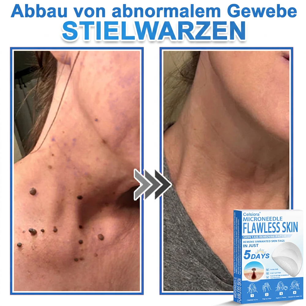 👩‍⚕️ Curalona® 2-in-1 Microneedle & Hydrocolloid Patches | Advanced Skin Care Patches for Blemishes, Skin Tags & Uneven Skin Texture | Helps Improve the Look of Fine Lines, Marks & Imperfections | Invisible Star Spot Patches for Face & Body