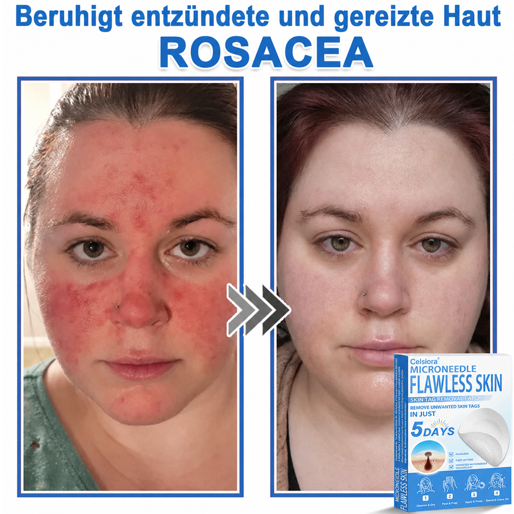 👩‍⚕️ Curalona® 2-in-1 Microneedle & Hydrocolloid Patches | Advanced Skin Care Patches for Blemishes, Skin Tags & Uneven Skin Texture | Helps Improve the Look of Fine Lines, Marks & Imperfections | Invisible Star Spot Patches for Face & Body