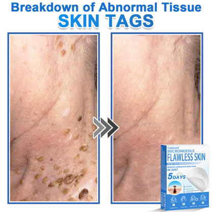 👩‍⚕️ Curalona® 2-in-1 Microneedle & Hydrocolloid Patches | Advanced Skin Care Patches for Blemishes, Skin Tags & Uneven Skin Texture | Helps Improve the Look of Fine Lines, Marks & Imperfections | Invisible Star Spot Patches for Face & Body